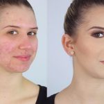¿Cómo maquillar la piel con acné?